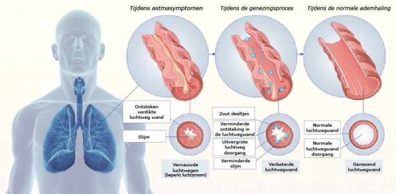 luchtreiniger tegen klachten van astma